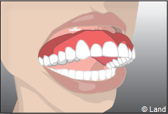 La prothese amovible