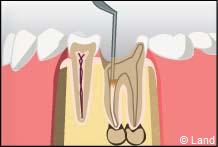 traitement radiculaire