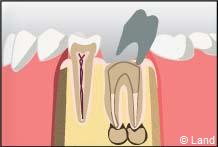 traitement radiculaire